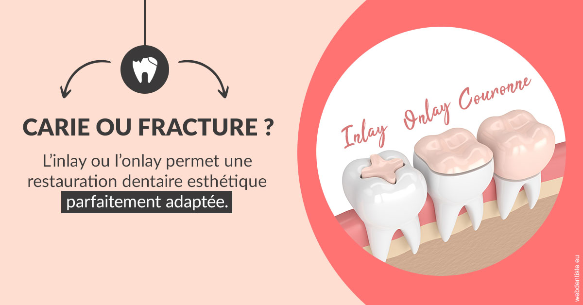 https://selarl-dr-nathan-michele.chirurgiens-dentistes.fr/T2 2023 - Carie ou fracture 2