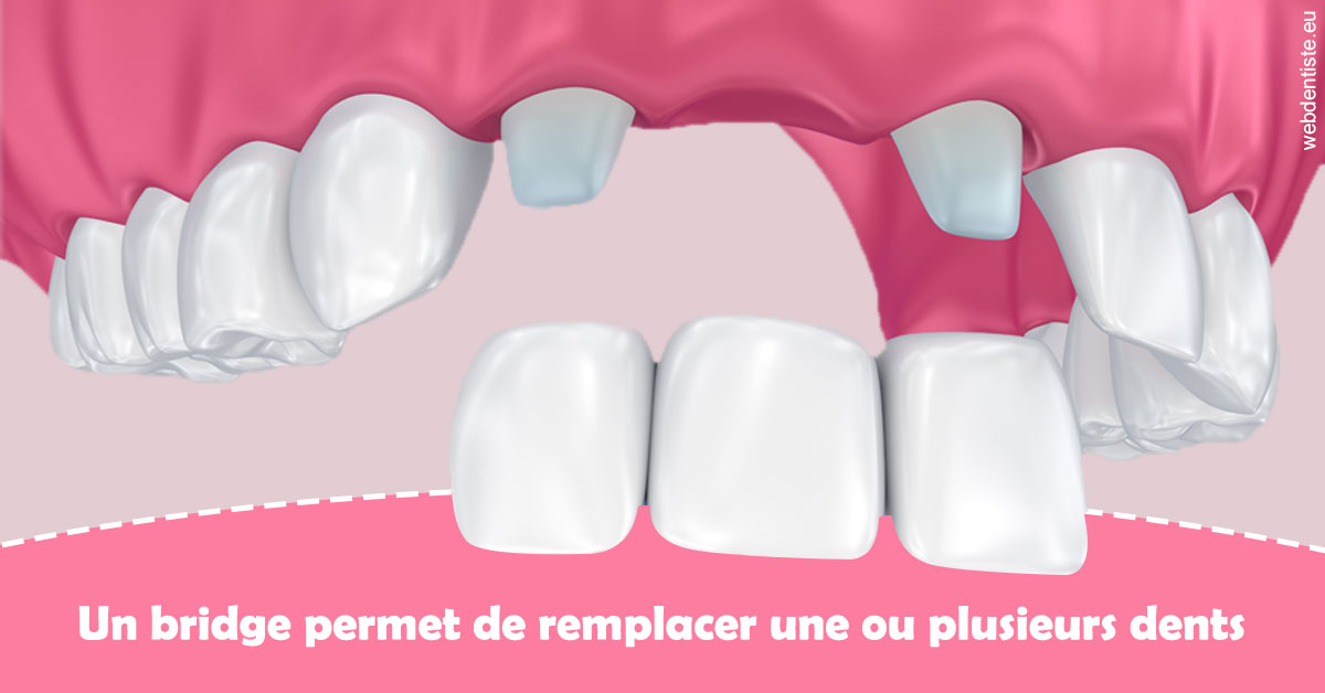 https://selarl-dr-nathan-michele.chirurgiens-dentistes.fr/Bridge remplacer dents 2