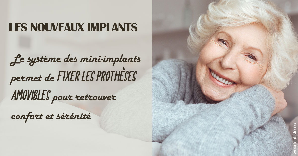 https://selarl-dr-nathan-michele.chirurgiens-dentistes.fr/Les nouveaux implants 1