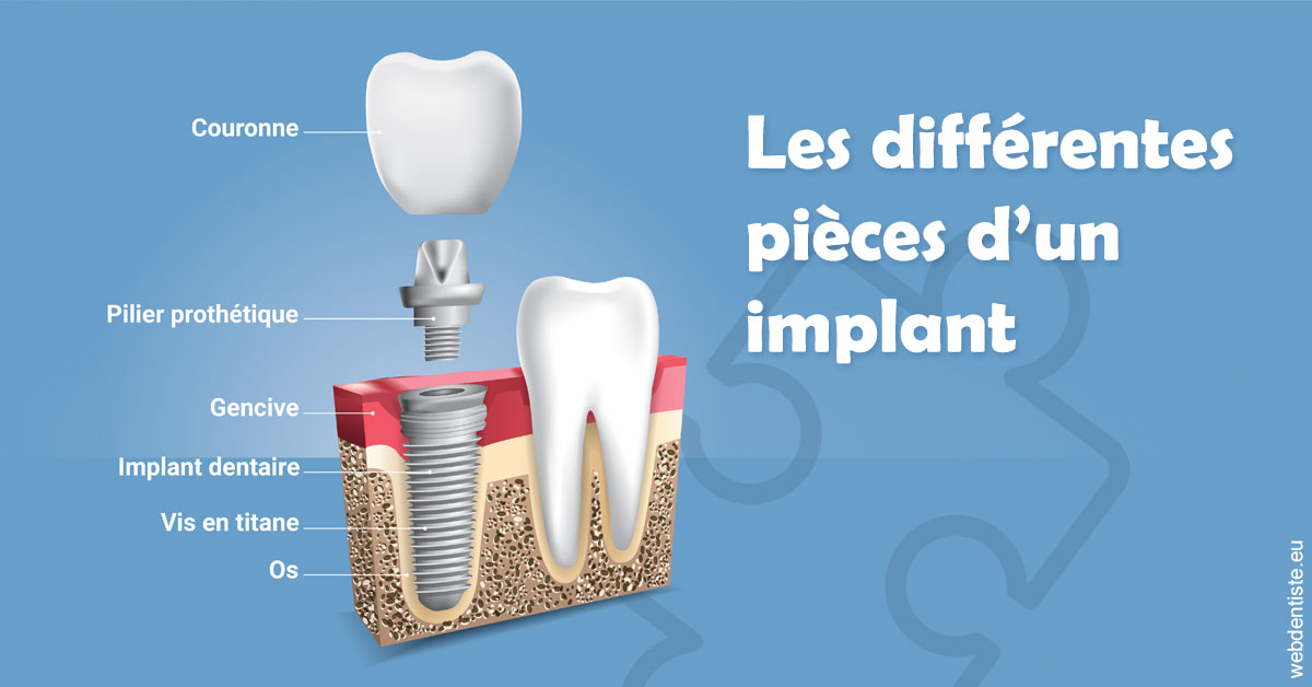 https://selarl-dr-nathan-michele.chirurgiens-dentistes.fr/Les différentes pièces d’un implant 1