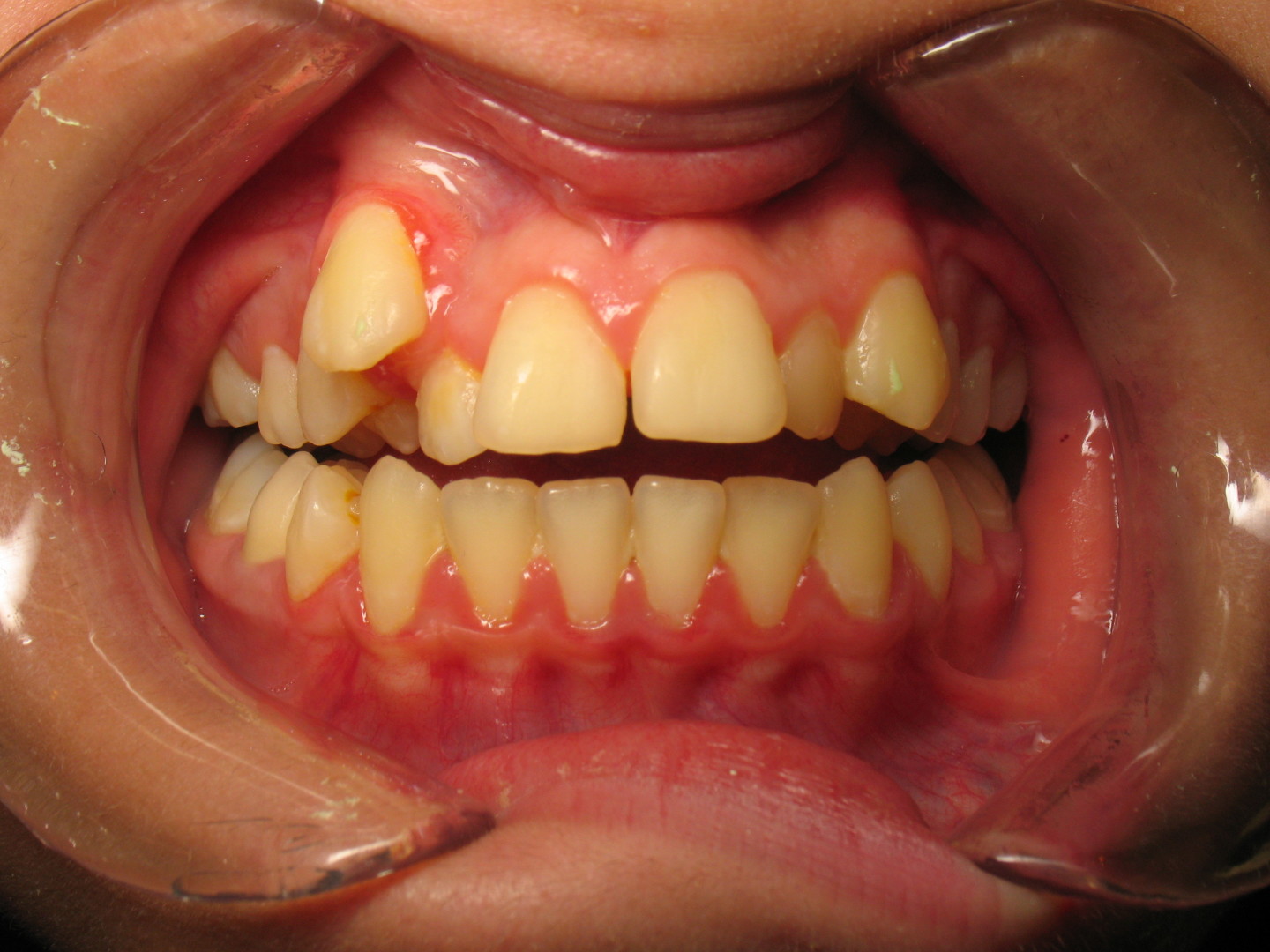 alignement redressement dentaire sur beance (1)  avant