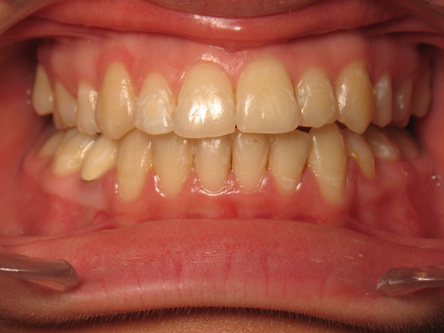 alignement redressement dentaire sur beance (2)  apres